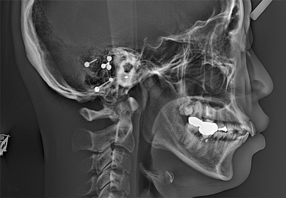 발치교정 X-ray